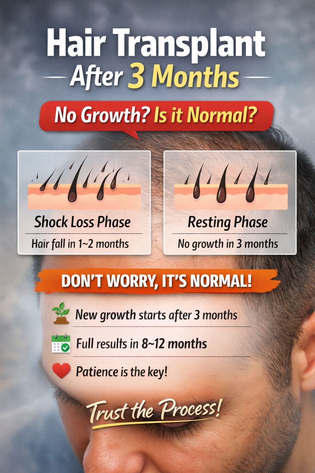 hair-transplant-after-3-months-no-growth-normal