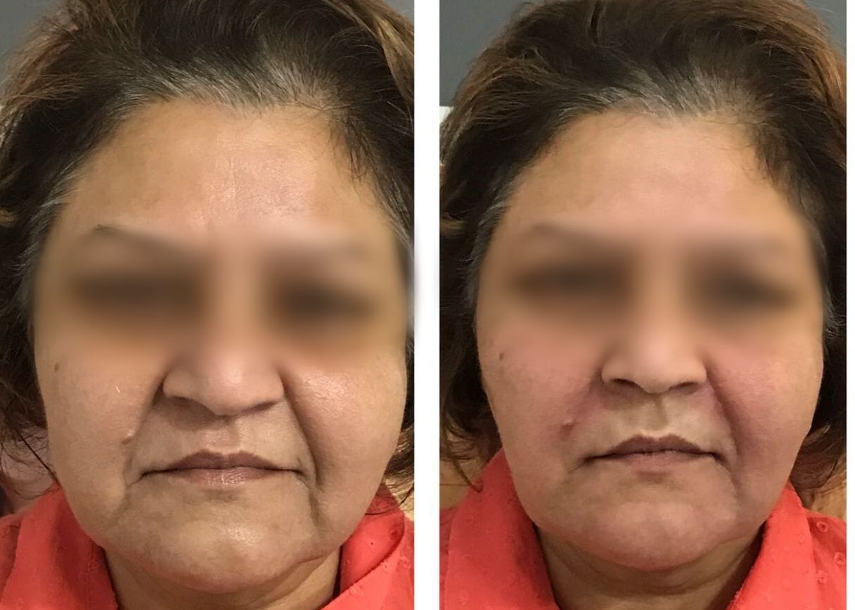 Anti-Ageing Treatments