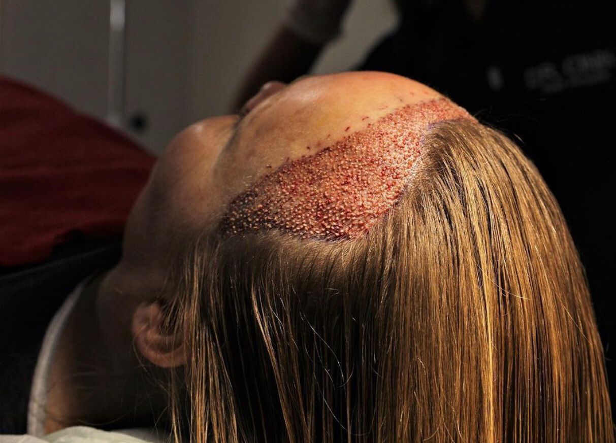 Female Hair Transplant